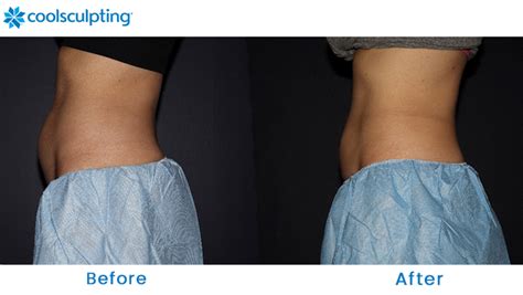 coolsclupting|coolsculpting stomach before and after.